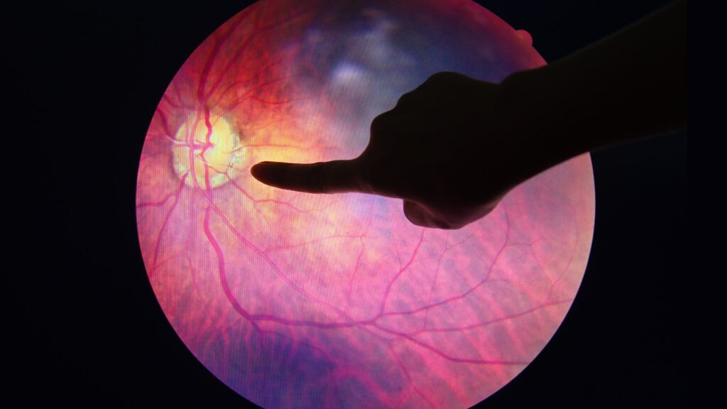 Diabetinė retinopatija
