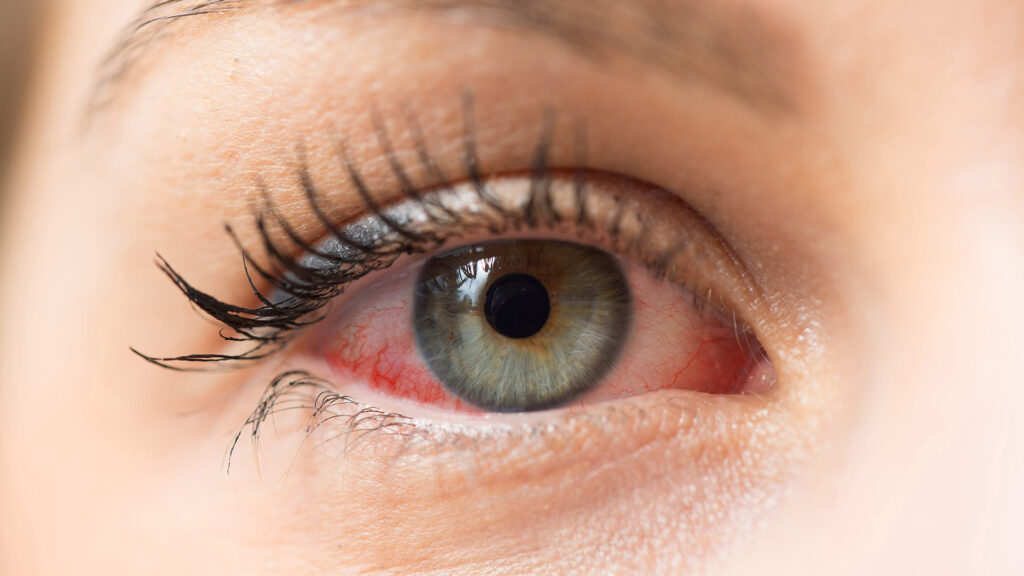 Sausų akių sindromas
