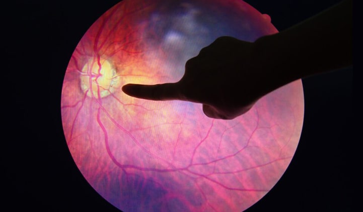 Rodoma, kaip atrodo diabetinė retinopatija