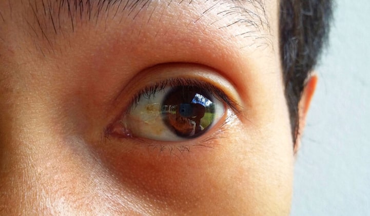 Hialinės distrofijos (pinguecula) pažeista akis