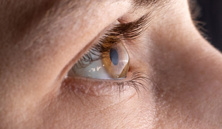 Akių liga keratokonusas iškreipia ragenos formą