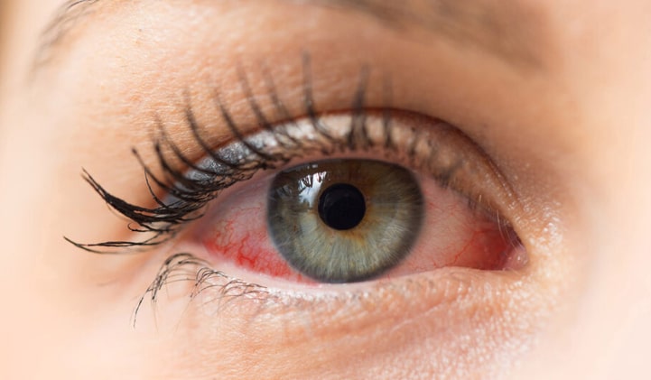 Sausų akių sindromas matomas ant akies