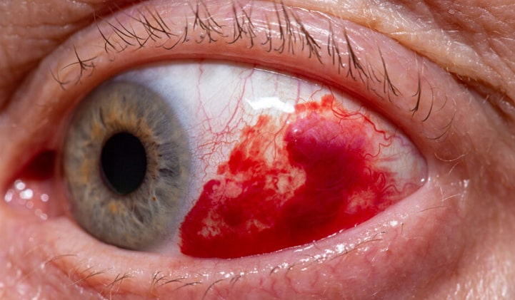 Subkonjunktyvinis kraujavimas akyje
