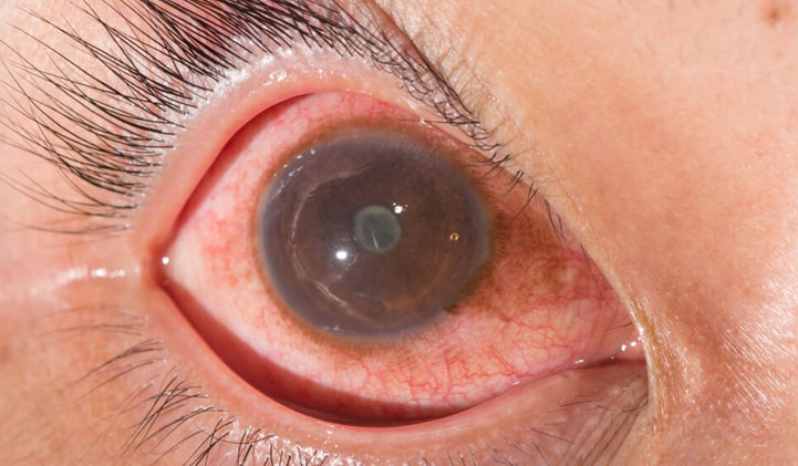 Uveito ligos pažeista akis
